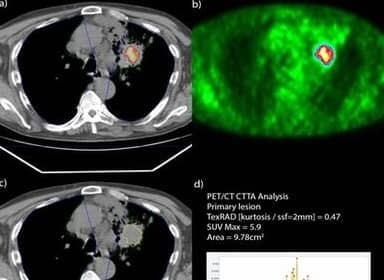 PET/CT in lung cancer analysis assisted with radiomic-based features
