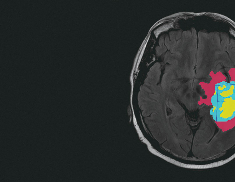Automatic brain tumor segmentation with subregions