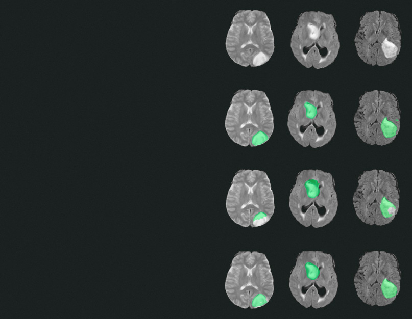 Segmenting pediatric optic pathway glioma from MRI using deep learning