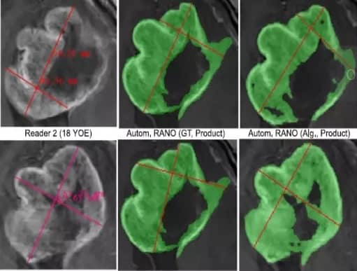 Automated RANO solution for clinical trial