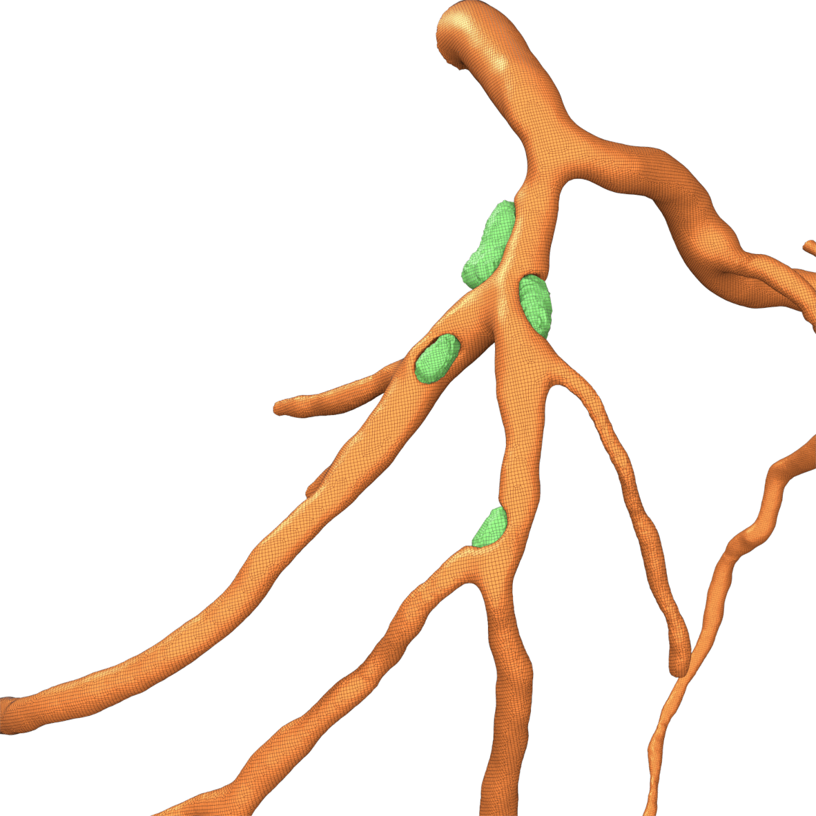 reconstruction of coronary vessel geometry and calcified plaques