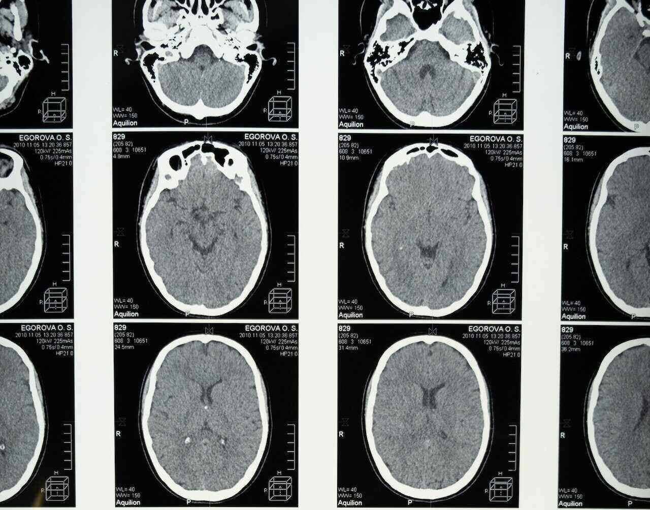 brain scans without brain tumor segmentation performed yet