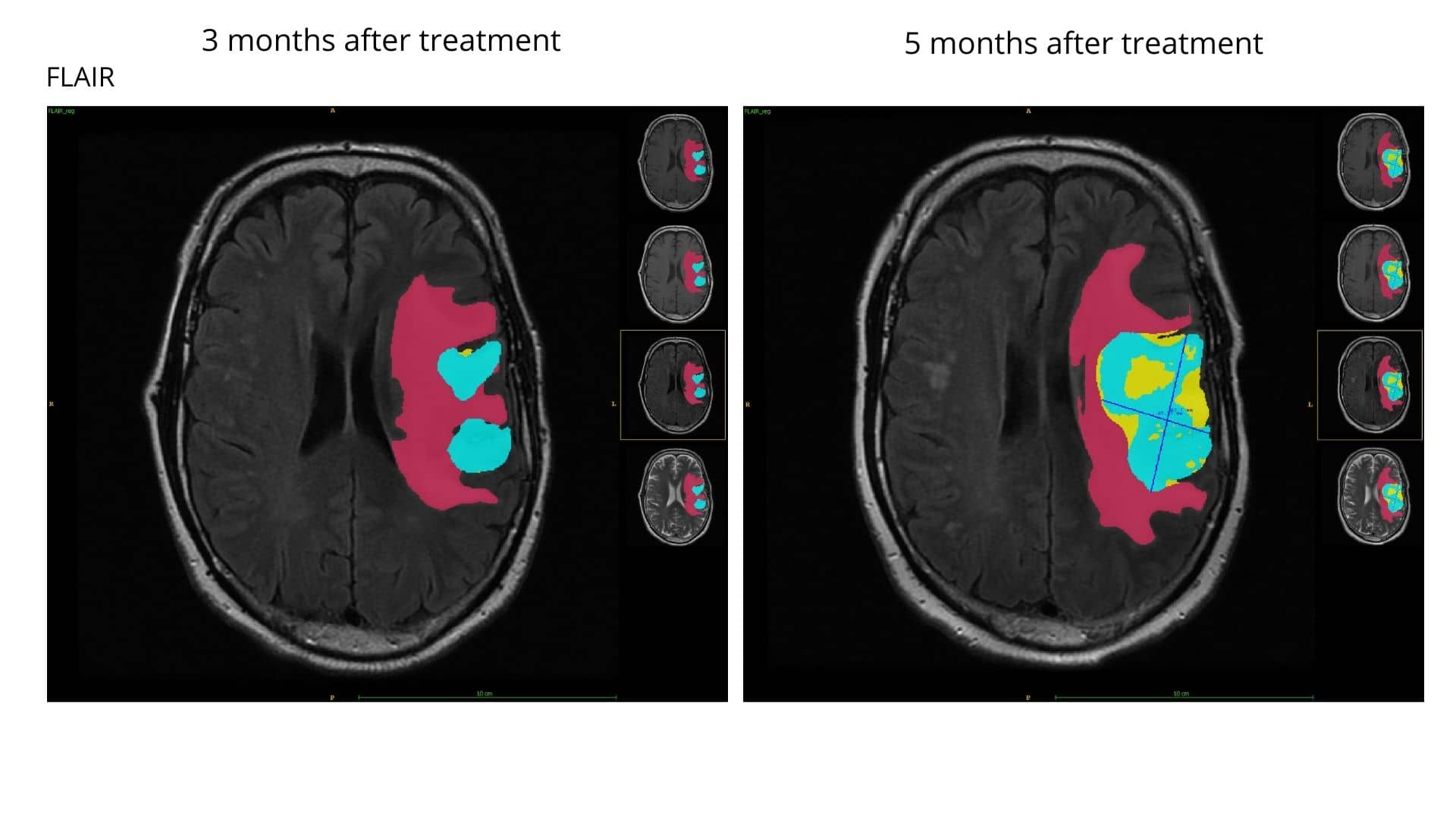 Automatic Brain Tumor Segmentation With Subregions - Graylight Imaging