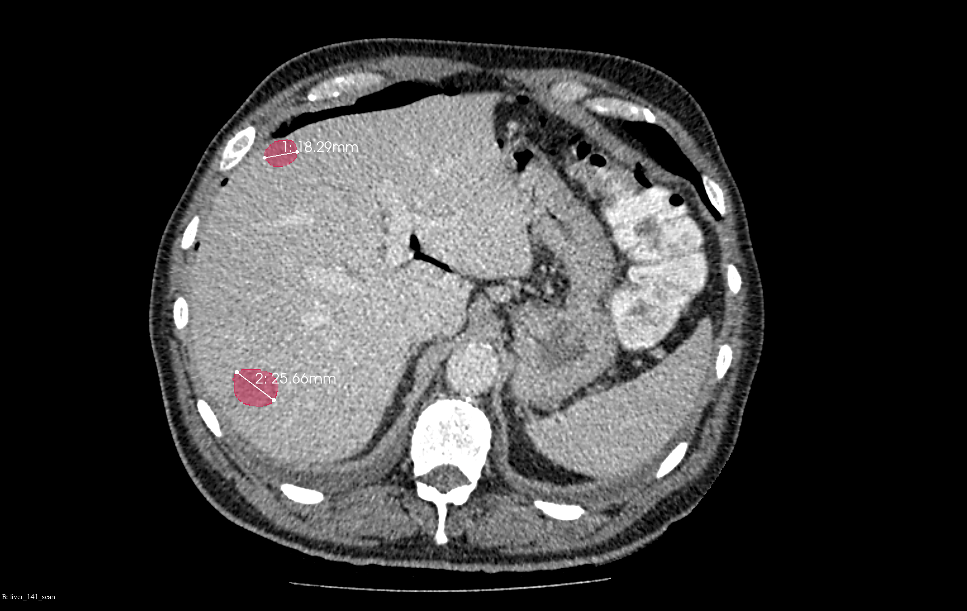 Liver CT image with segmented and measured lesions, RECIST