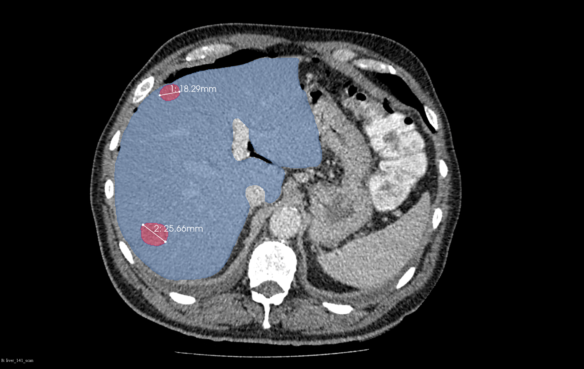 Liver CT scan from project for the pharmaceutical industry with automatically segmented liver and HCC tumors