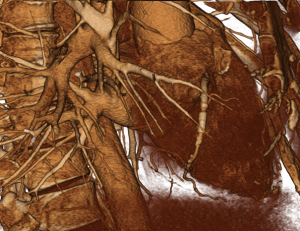 3D model of Coronary arteries with stent based on 3d medical image processing