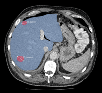 Liver CT image with segmented lesions and liver itself