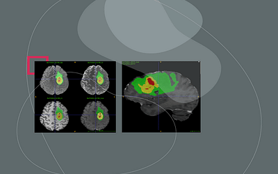 Graylight Imaging Data Scientists top ranked in RSNA-ASNR-MICCAI 2021 Brain Tumor Segmentation (BraTS) Challenge