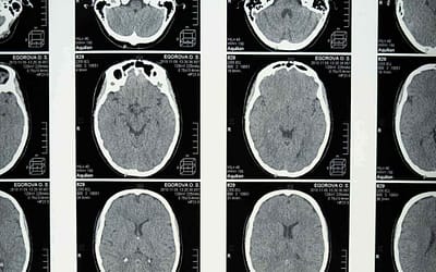 Brain tumor segmentation challenges – Graylight Imaging’s success