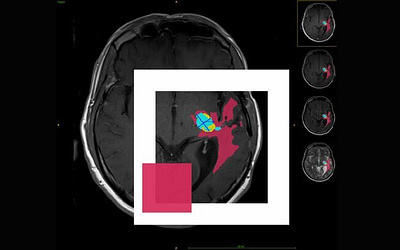 BioTechX – our brain tumor segmentation algorithm