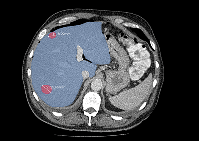 Liver and liver tumor segmentation and analysis algorithms
