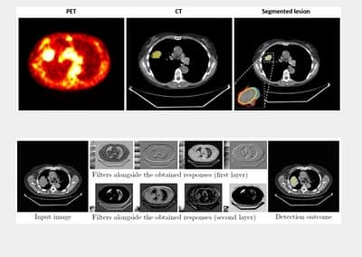 Research study: delineating high-uptake lung lesions from CT scans