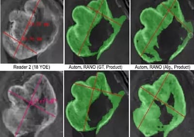 Automated RANO solution for clinical trial
