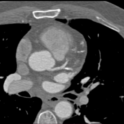 medical image of Coronary Computed Tomography Angiography