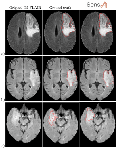 brain dicoms with glioma contouring proving the quality of segmentation in medical image analysis