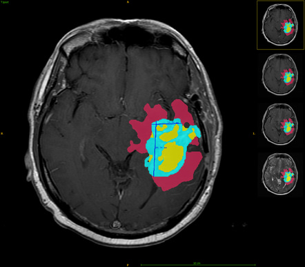 automatic brain tumor segmentation patient's MRI that was automatically segmented 3 tumor subregions (edema, enhancing tumor and necrosis) and provide volume and RANO (Response assessment in neuro-oncology) measurements, DIOM, regression