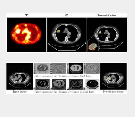 lung lesions from CT scans from delineating high-uptake lung lesions from CT scans - Graylight Imaging project