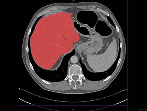Liver CT scan from project for the pharmaceutical industry with example of radiomic feature