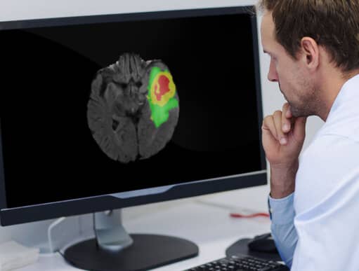 At the picture we can see the doctor who is working on the computer using software for segmentation of postoperative glioma.
