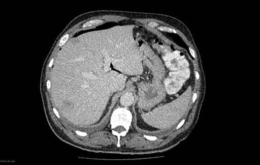 image to content of liver tumor analysis: liver CT image