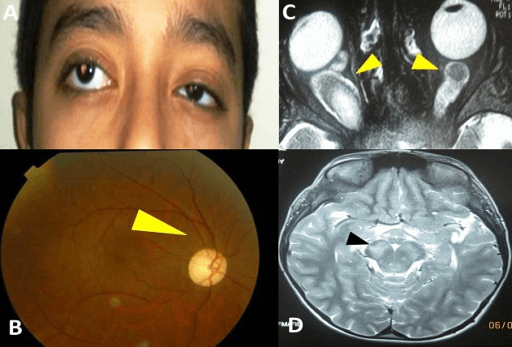 a boy with pediatric optic nerve glioma and his MRI examinations