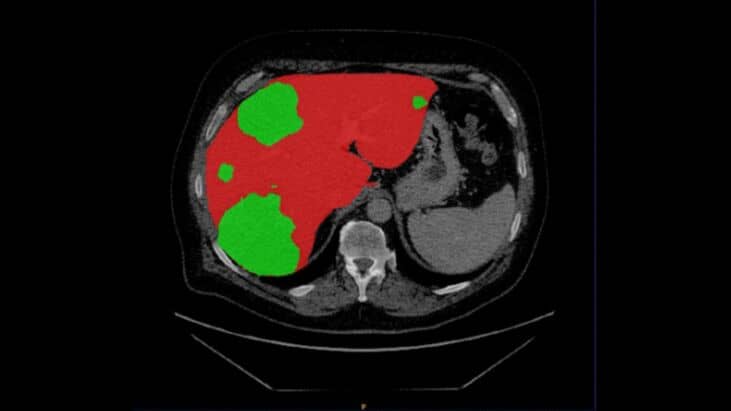 the picture presented liver tumor segmentation