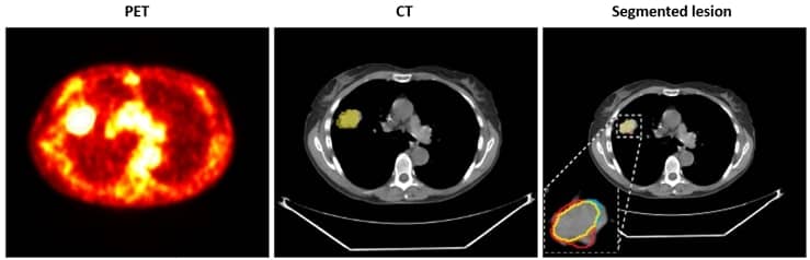 lungs lesions
