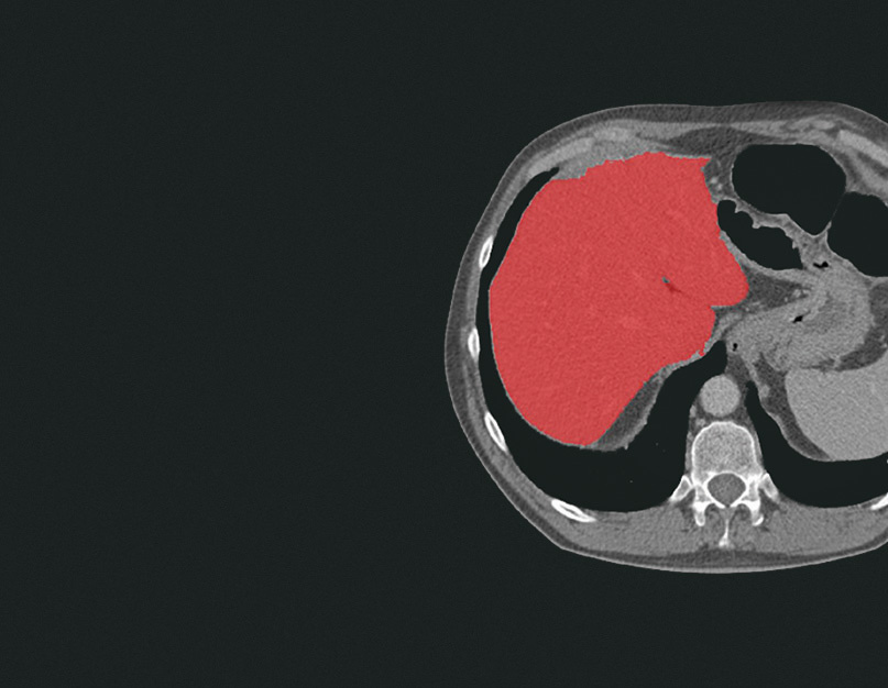 Cirrhosis Detection From Ct Scans Graylight Imaging 1279