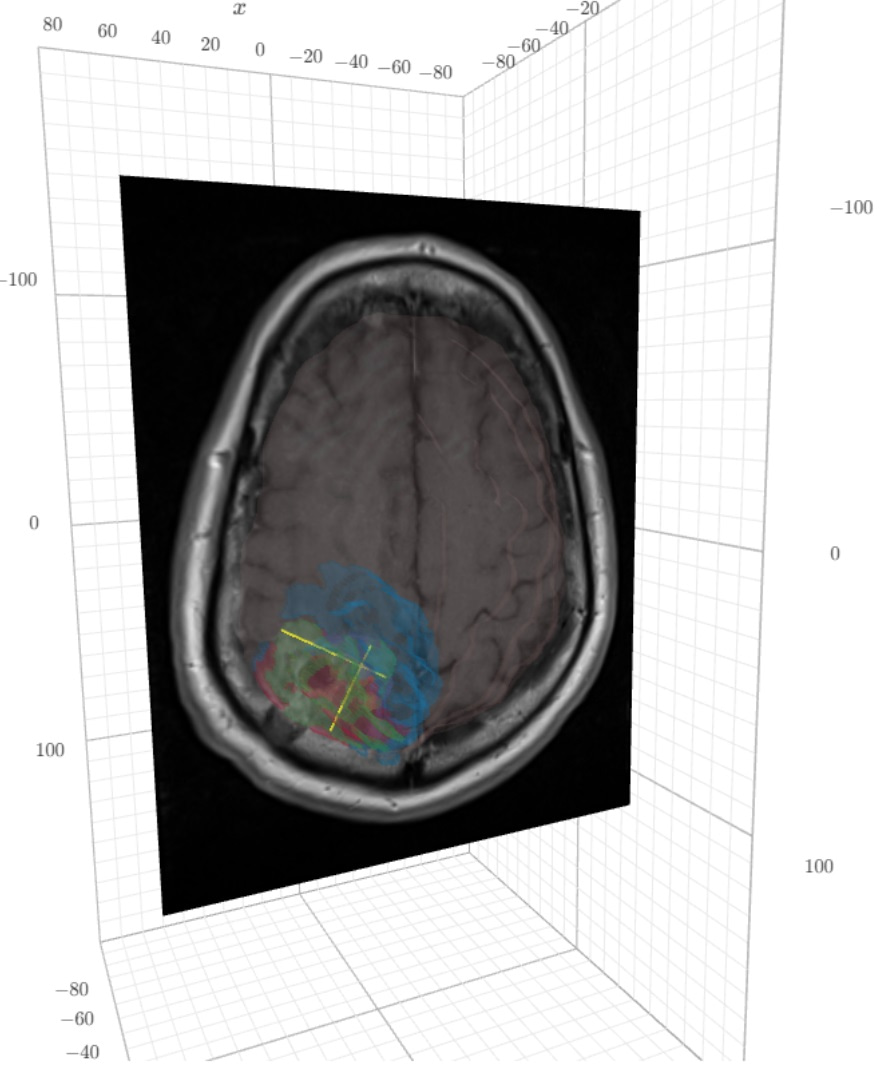 Brain MRI image with segmented lesion and its subregions