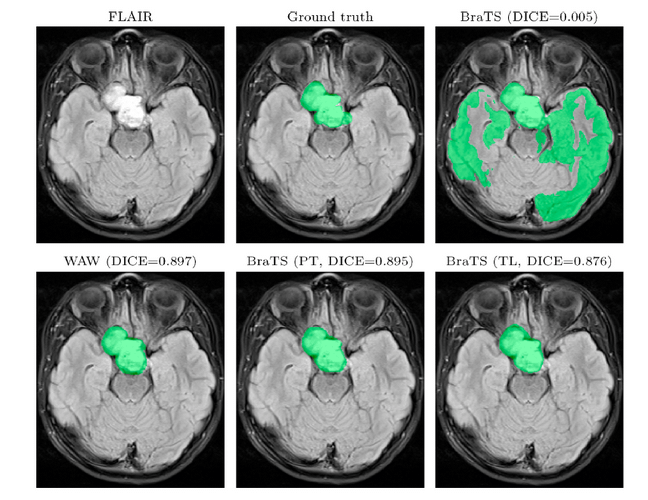 Segmenting pediatric optic pathway glioma from MRI using DL