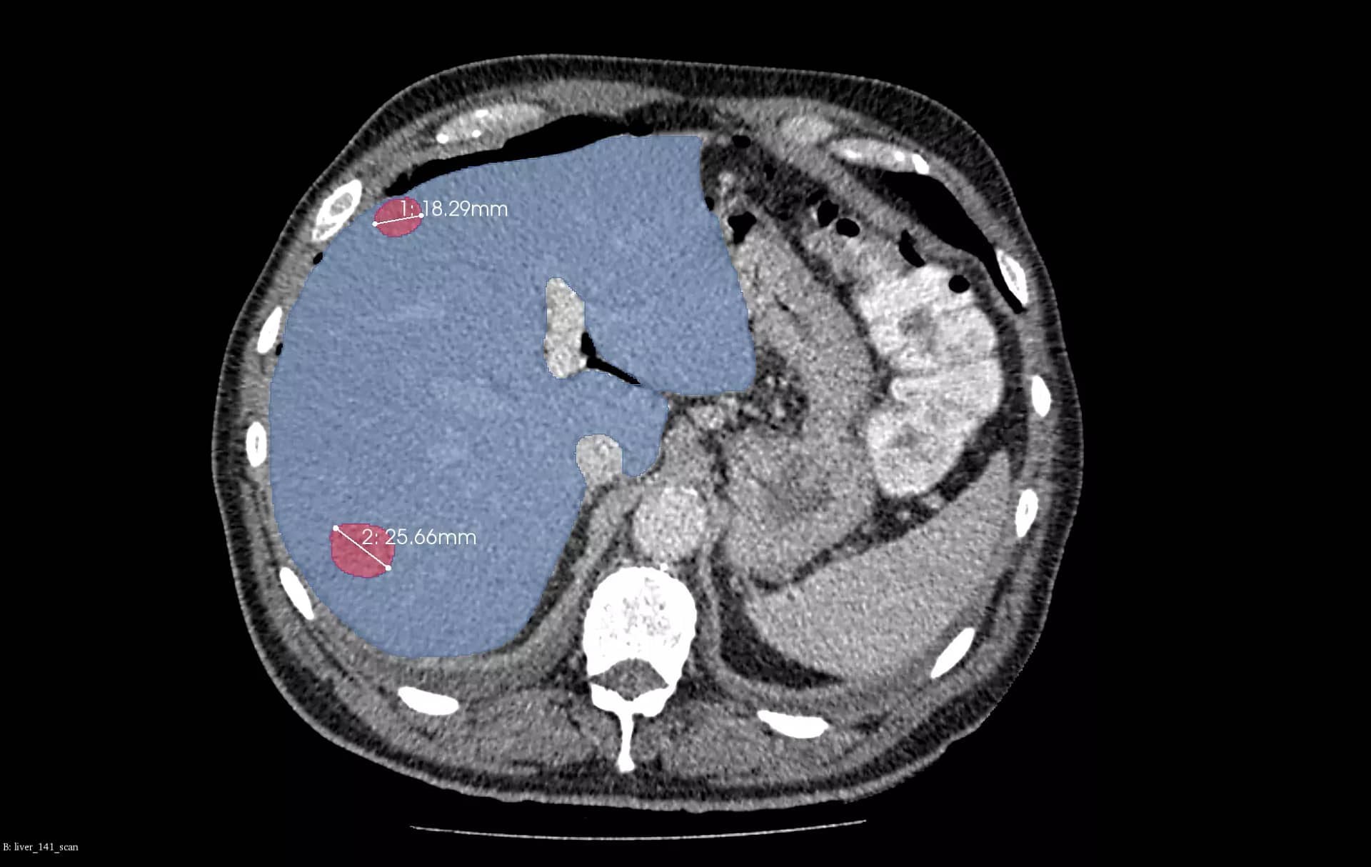 liver-and-liver-tumor-segmentation-and-analysis