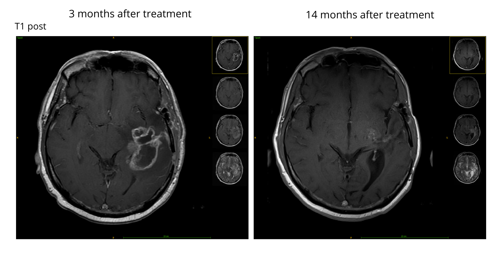 brain tumor segmentation without using AI